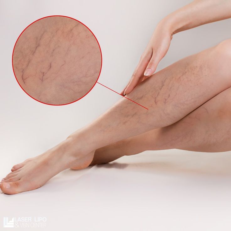 Varices