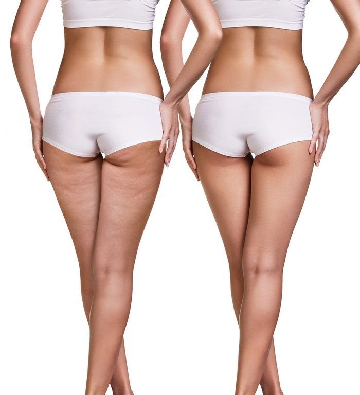 celulitis