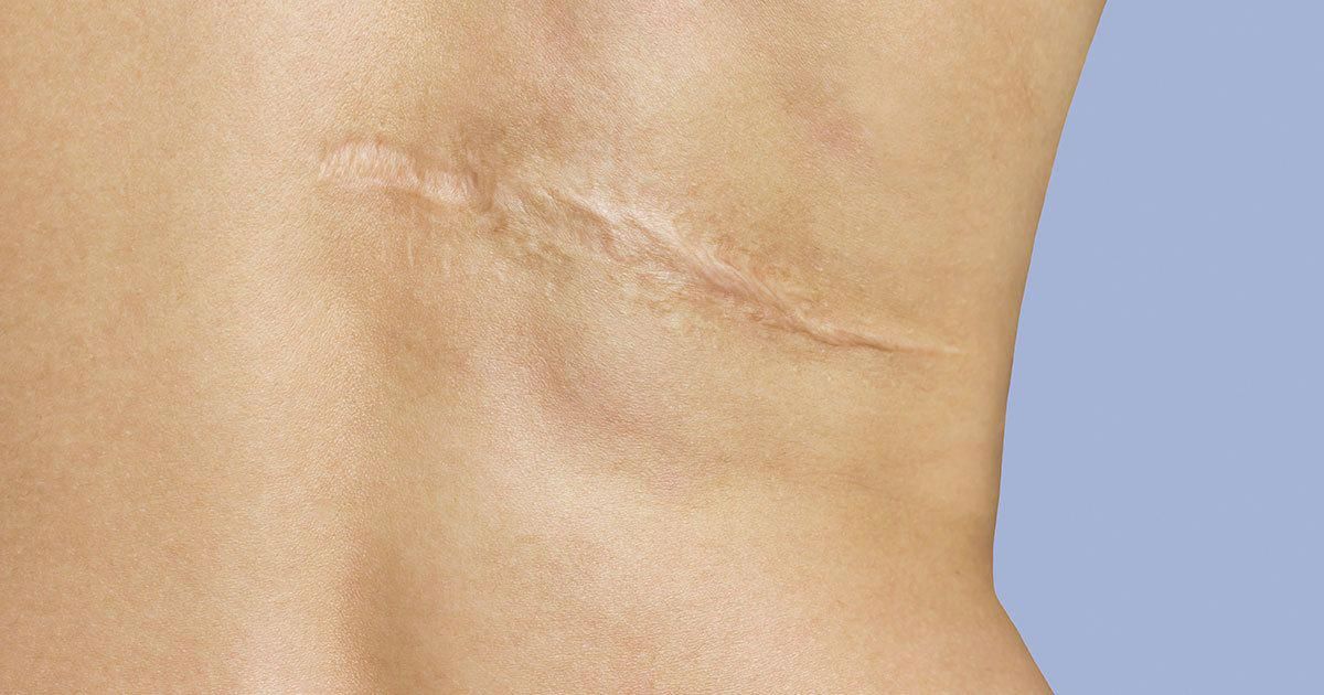 HERIDAS, CICATRICES Y QUEMADURAS